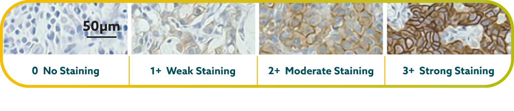 Membrane staining of tumor cells for "0 No Staining," "1+ Weak Staining," "2+ Moderate Staining," and "3+ Strong Staining."